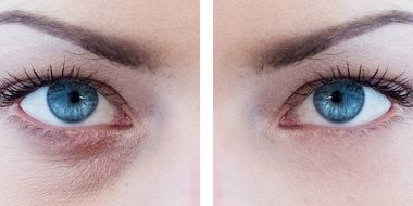 آموزش تصویری از بین بردن سیاهی زیر چشم در فتوشاپ