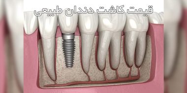 قیمت کاشت دندان طبیعی