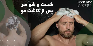 نحوه شست و شو سر بعد از کاشت مو سر چگونه است؟